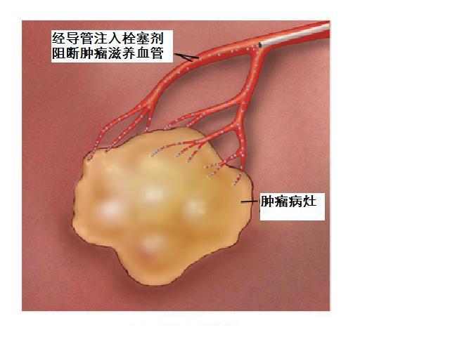 原发性肝癌的介入治疗 - 好大夫在线