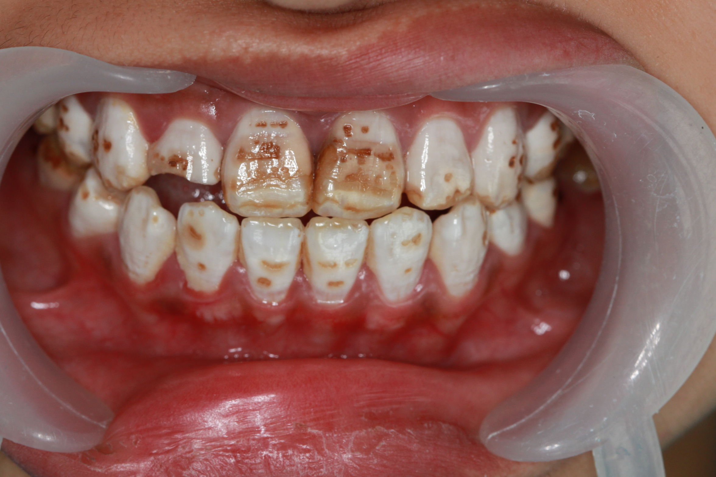 最严重的氟斑牙牙图片图片