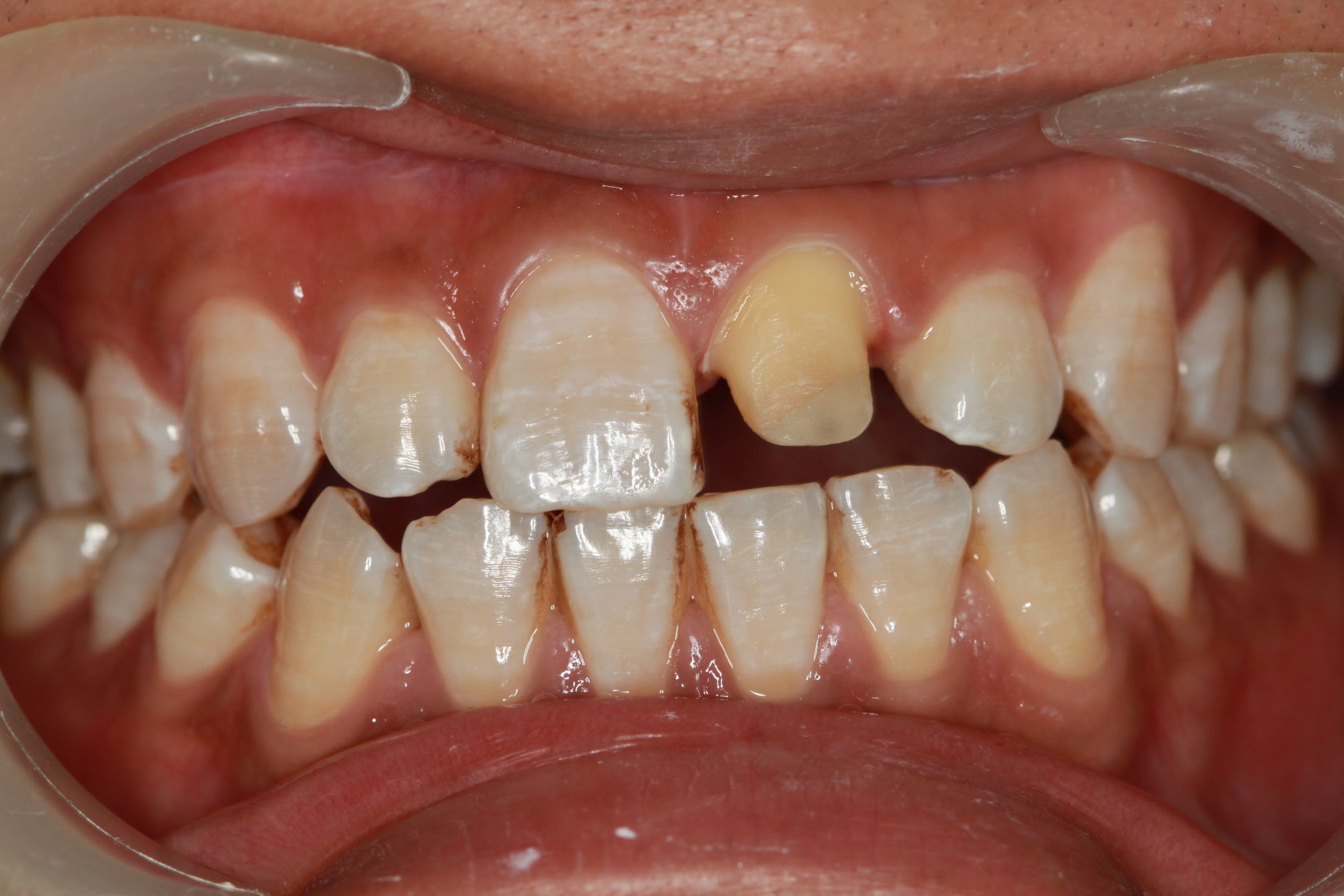 病例一:四环素牙的特殊染色 - 好大夫在线