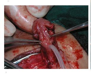 小儿尿道下裂手术图片