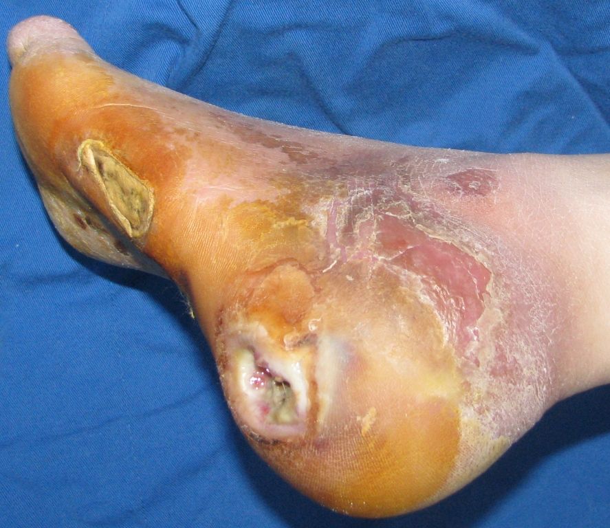 糖尿病足修复 - 好大夫在线