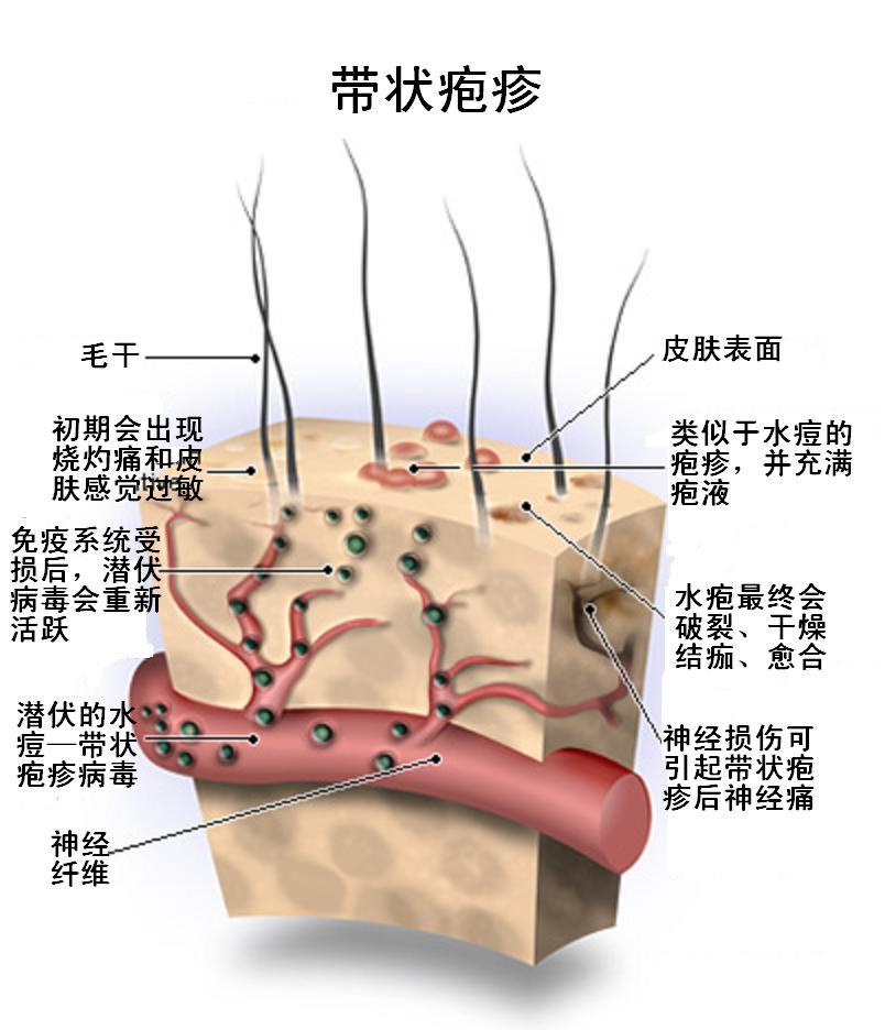 疱疹分几种图片