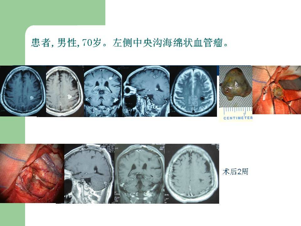 神經導航下切除大腦功能區海綿狀血管瘤