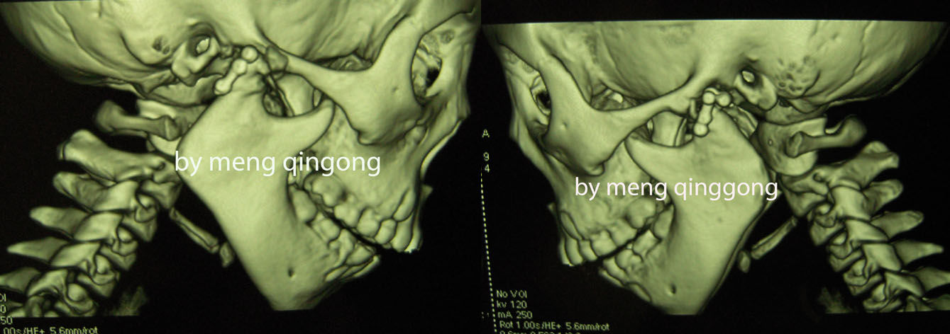 颞下颌髁突骨折术后发生关节强直喙突移植重建髁突有图片