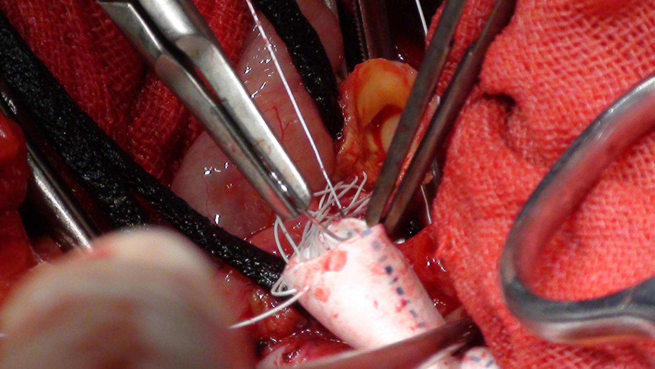 巨大腹主动脉瘤切除并人工血管置换术