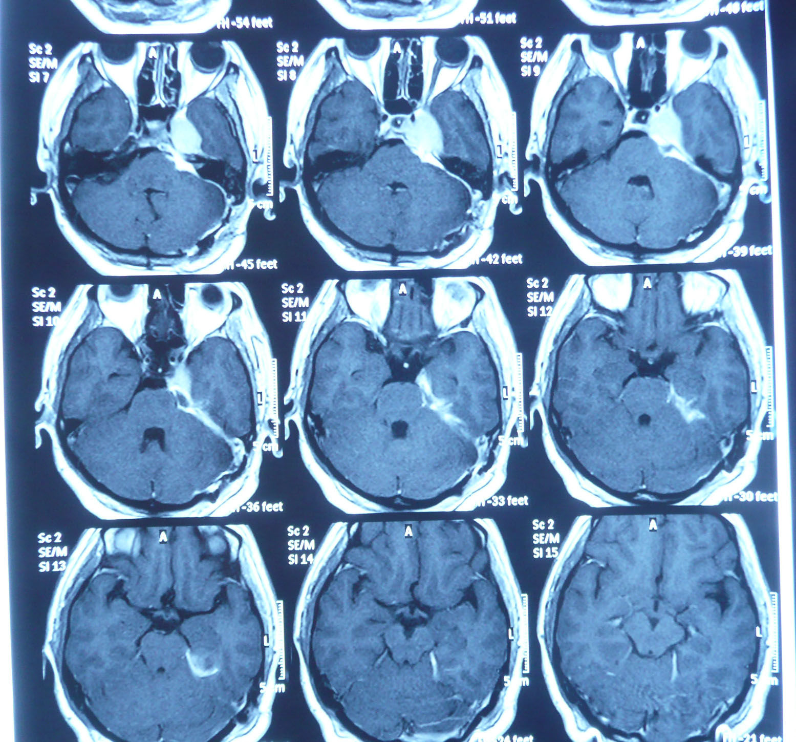 左橋小腦角左鞍旁巖尖騎跨性腦膜瘤外科切除策略賀教授手術追蹤