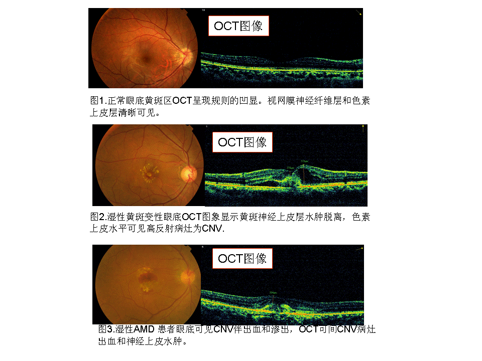 眼科oct检查图解 黄斑图片