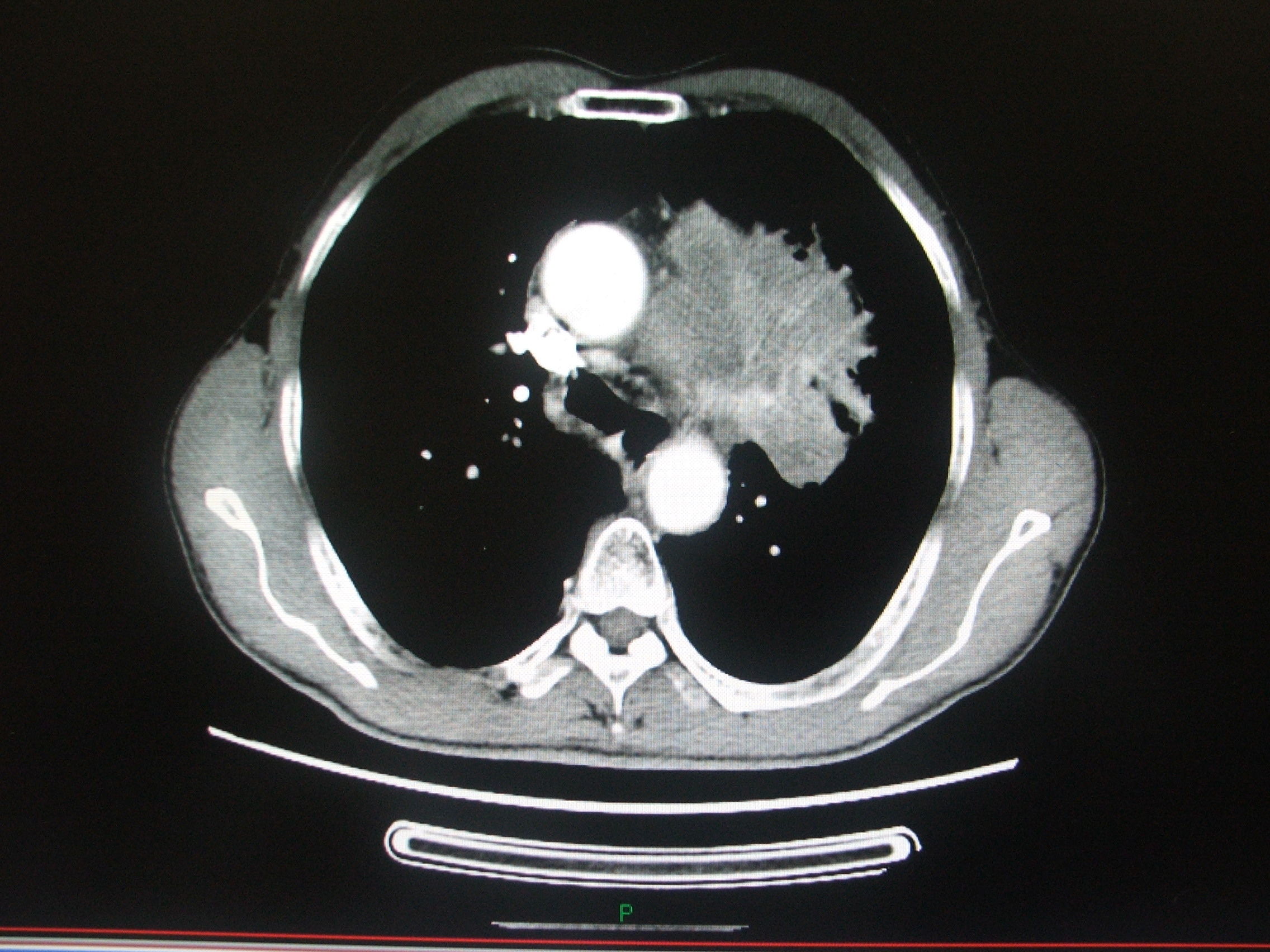 肺上长肿瘤严重吗 mip.haodf.com