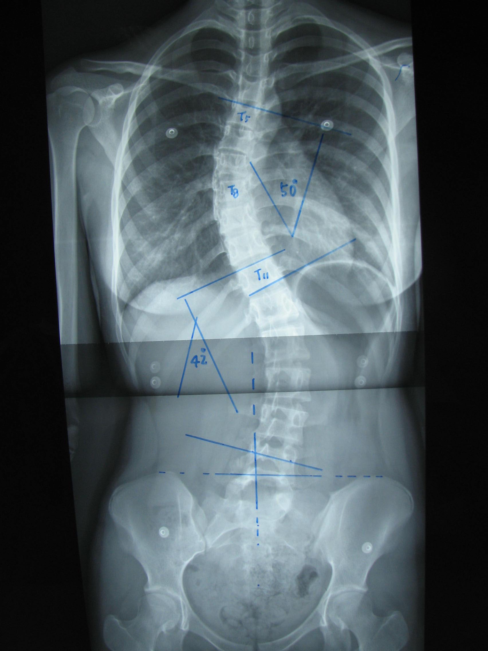 后路手术矫形治疗青少年特发性脊柱侧凸畸形(附图片资料) 