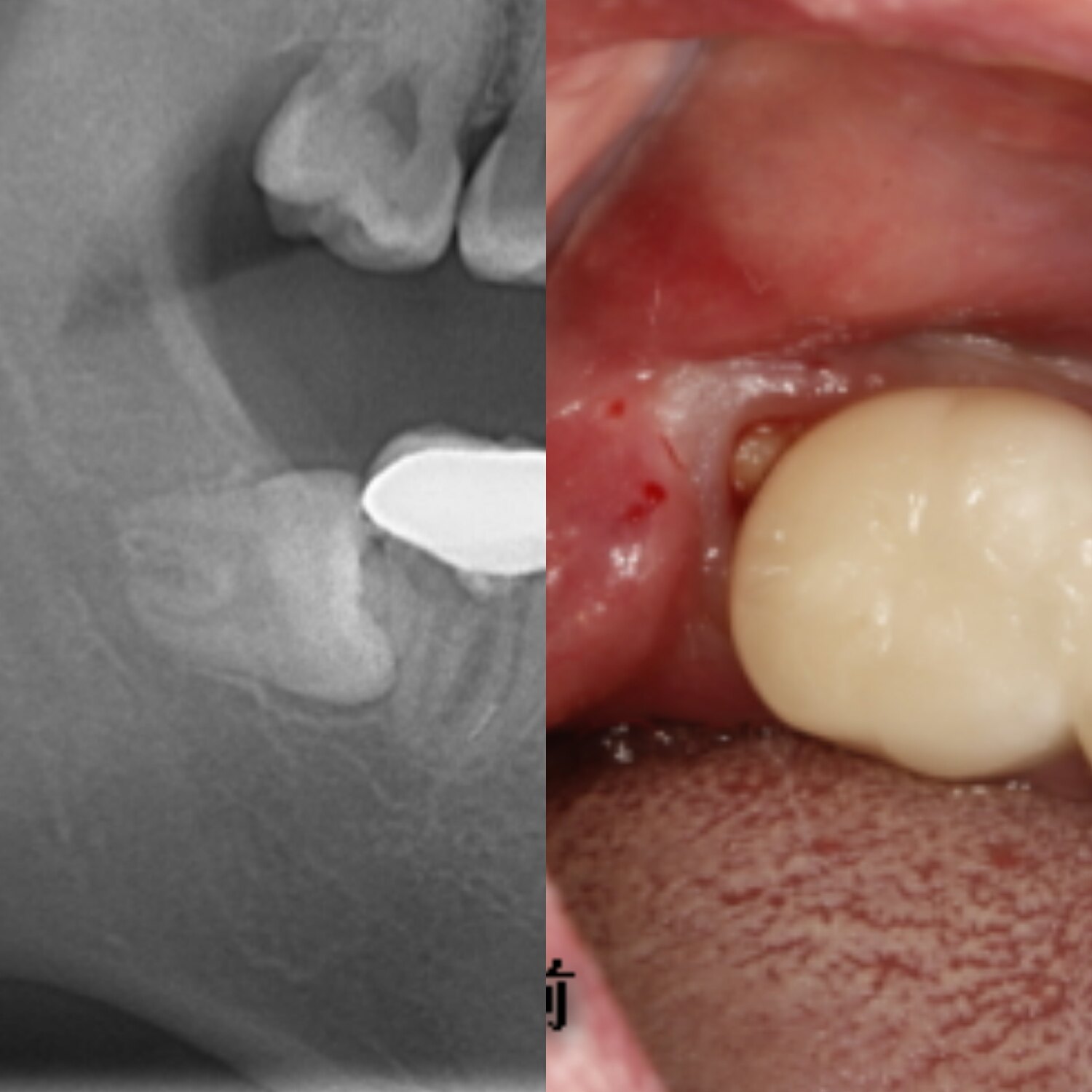 右下智齒水平低位阻生,口腔內只暴露了一點點牙齒先來看智齒的x線片.