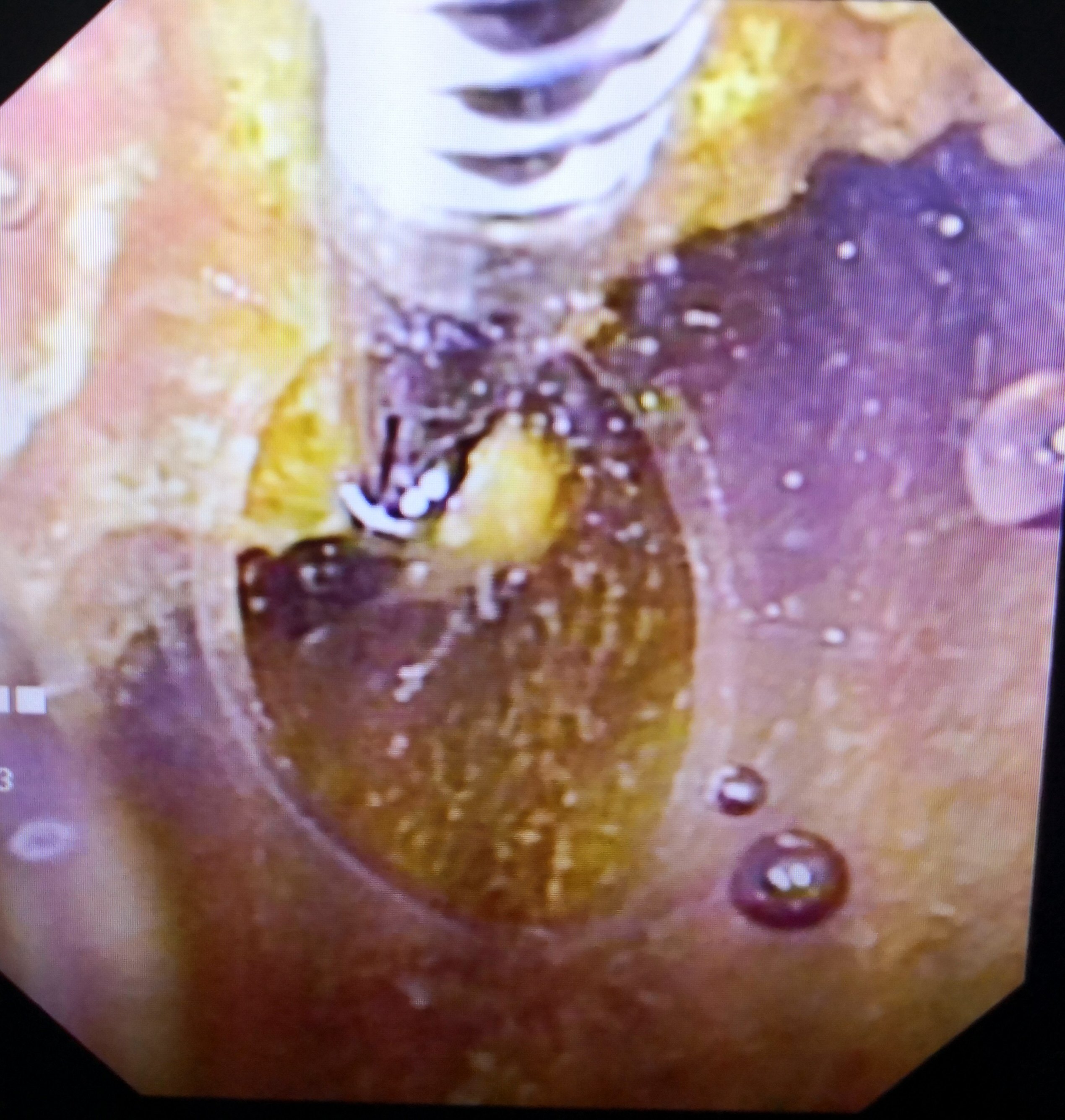 胆囊息肉如何治疗和预防(胆囊息肉如何治疗)-第2张图片-潮百科 胆囊息肉如何治疗和预防(胆囊息肉如何治疗)-第2张图片-潮百科