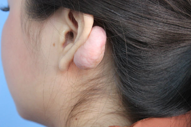 巨大型耳廓瘢痕疙瘩的手术治疗 