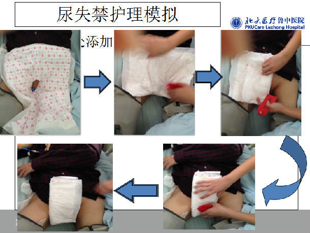 皮炎處理的經驗分享-男性失禁病人皮膚護理技巧