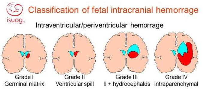 服务模式!新生儿脑水肿"春回大地"-第2张图片-月末博客