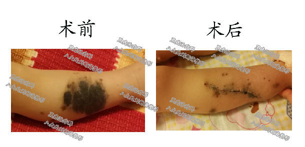 腿部黑痣切除手术效果图