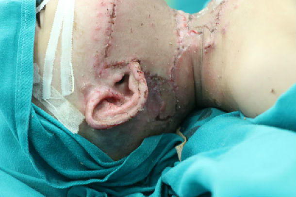 三度烧伤植皮一次全部成功的因素 - 好大夫在线