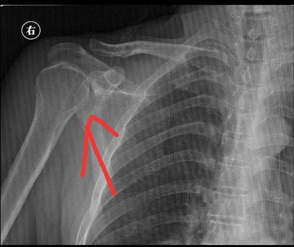肩关节半脱位 x线图片
