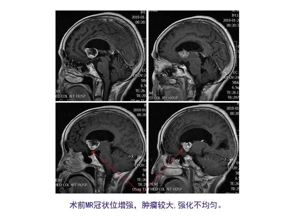 神经内镜endoport经右中回入路侧脑室,室间孔肿瘤 