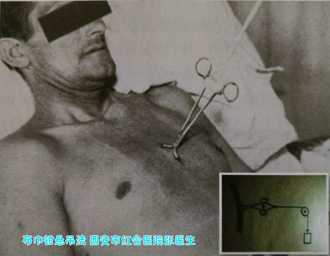 肋骨骨折手术治疗前世与今生 好大夫在线 肋骨骨折手术治疗前世与今生 好大夫在线