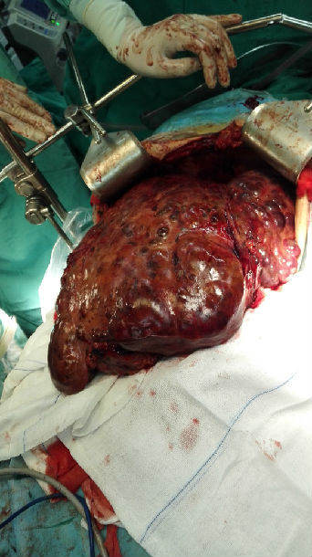 弥漫性肝癌,切除肝脏重量16斤(正常1000克) - 好大夫在线