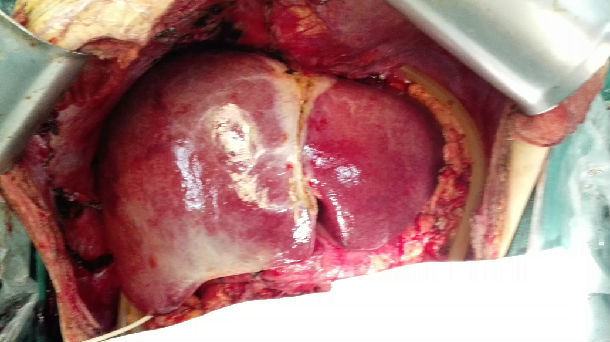 弥漫性肝癌,切除肝脏重量16斤(正常1000克) - 好大夫在线