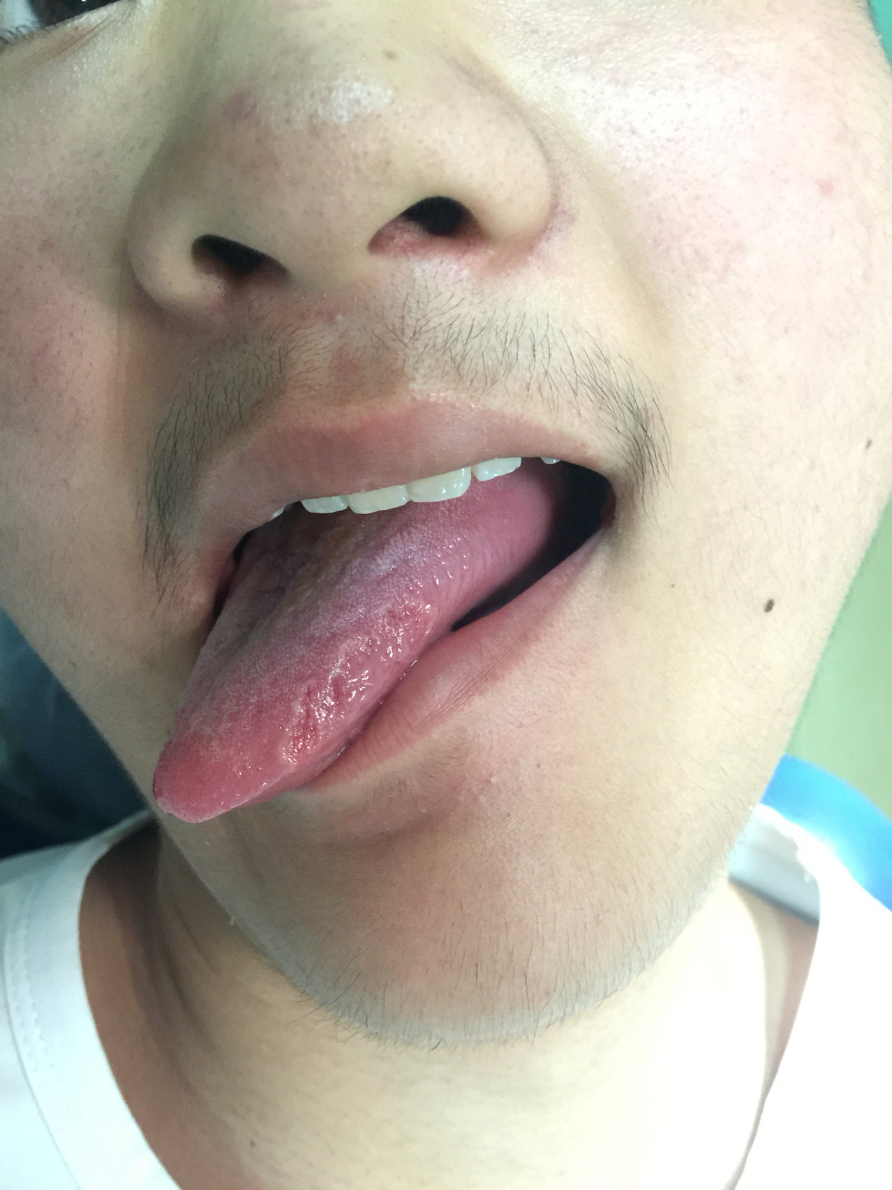 舌癌与非舌癌的图片比较 好大夫在线 舌癌与非舌癌的图片比较 好大夫在线
