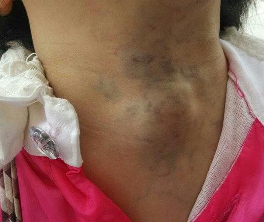 口腔颌面颈部静脉畸形 - 好大夫在线