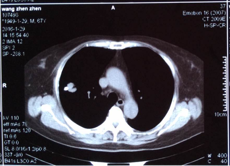 右肺结节消失了瘢痕癌的陀螺刀治疗