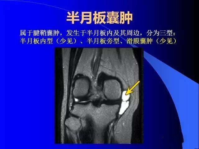半月板囊肿:多数半月板囊肿通常需要手术治疗.1.