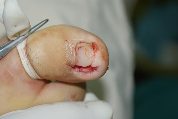指甲整形手术图片图片