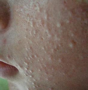 哪些是黑头粉刺?哪些是白头粉刺?