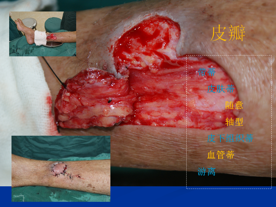皮肤移植基本概念 - 好大夫在线