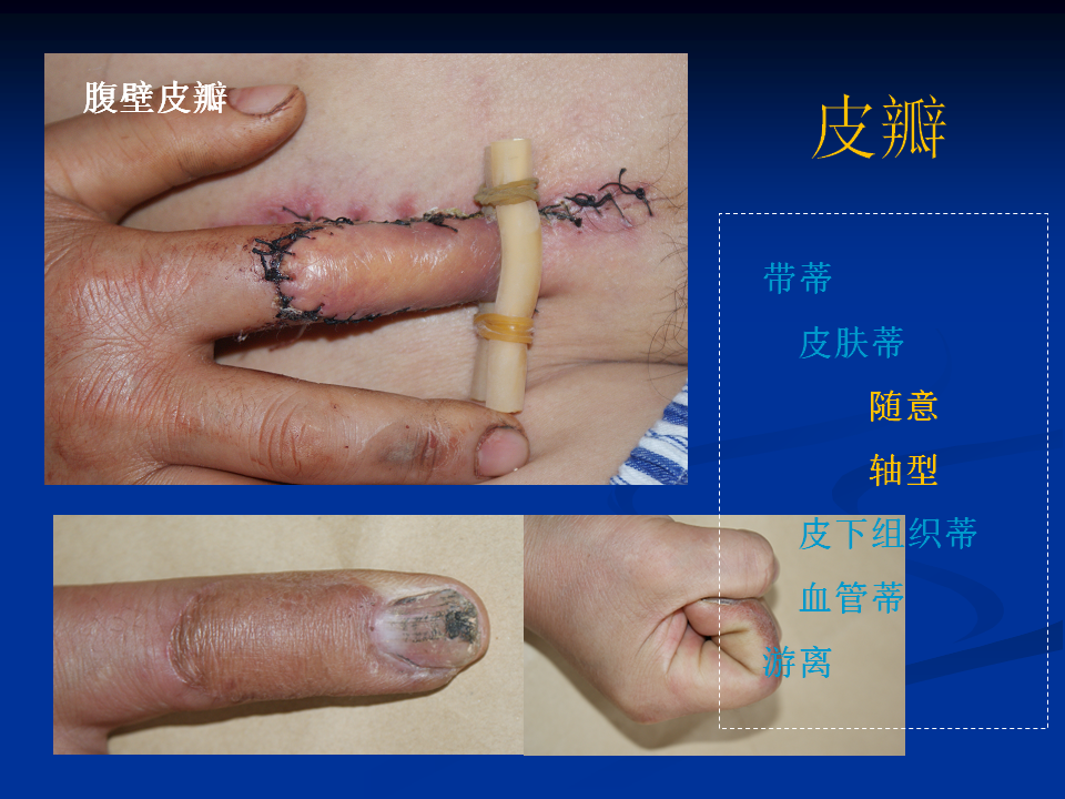 皮肤移植基本概念 - 好大夫在线