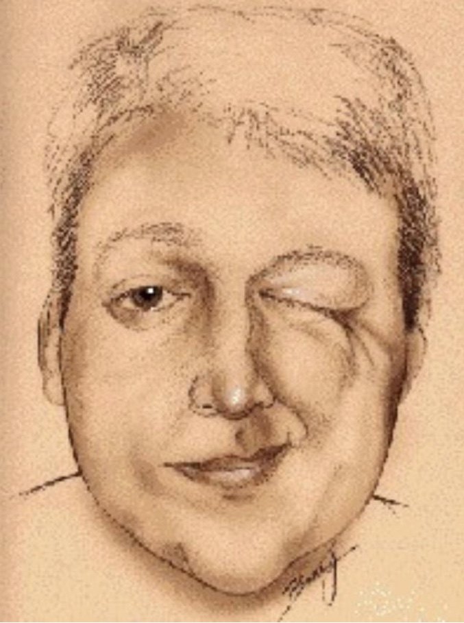 面肌痉挛 (hemifacial spasm,hfs) 是一种临床常见的脑神经疾病,其