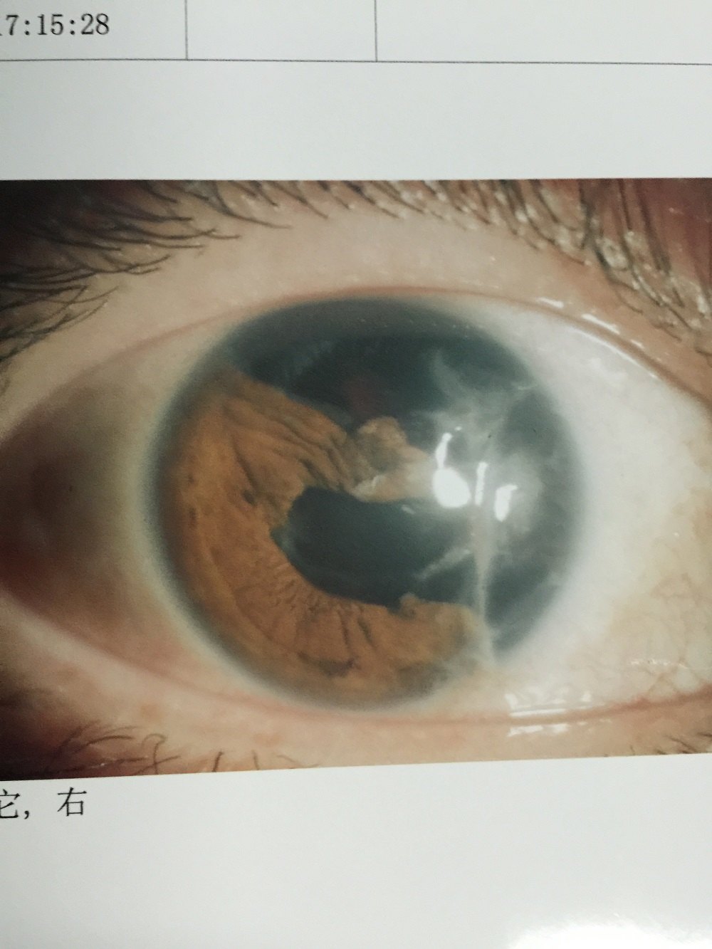 虹膜断离/缺损   瞳孔散大修复的病例