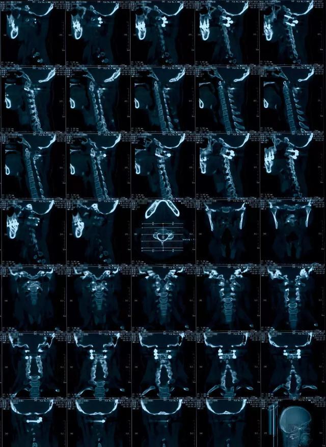 病例点评:寰枢椎脱位1例 - 好大夫在线