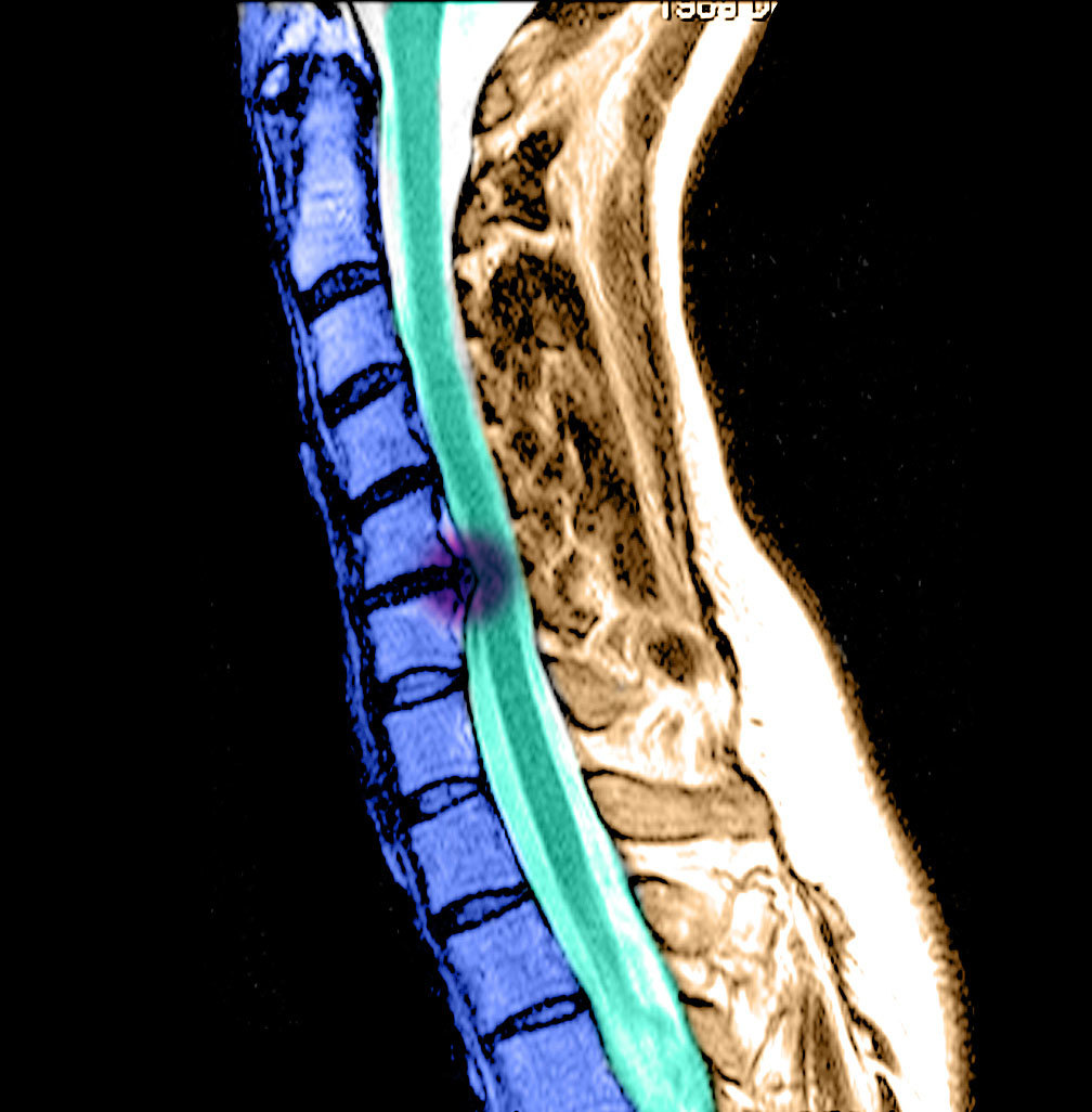 脊髓损伤后出现疼痛,该如何应对?