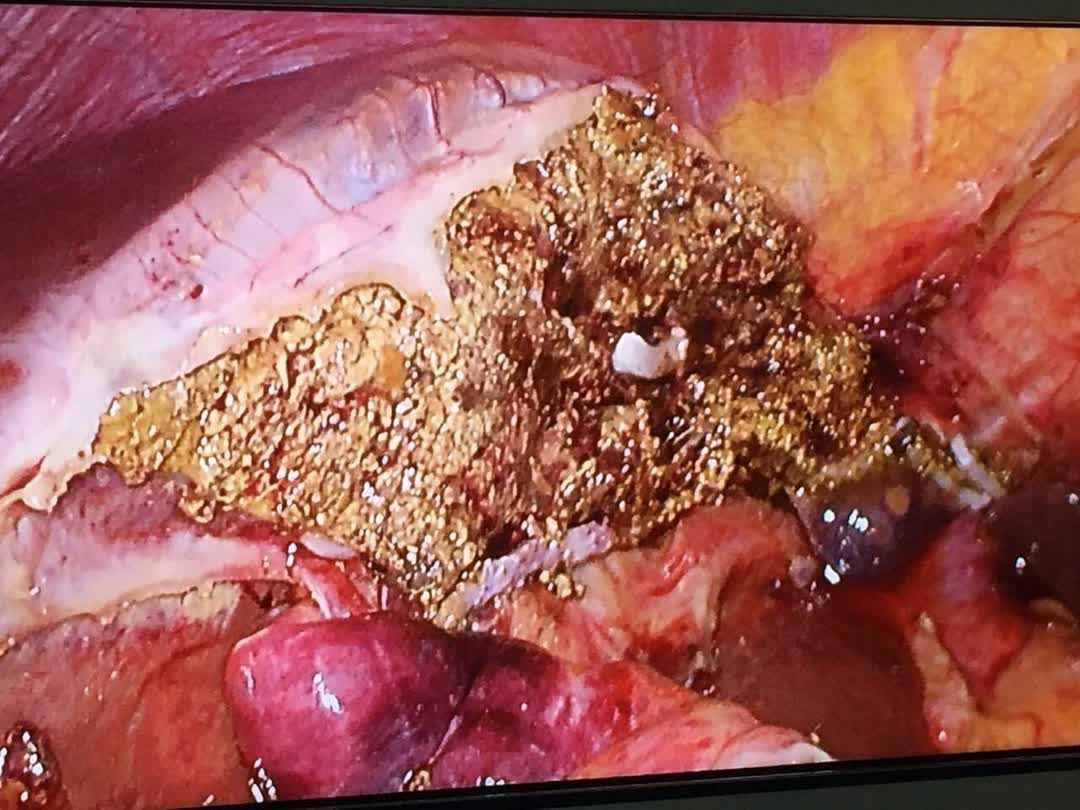 肝癌如何进行微创手术治疗_肝癌_手术_治疗方式 - 好大夫在线