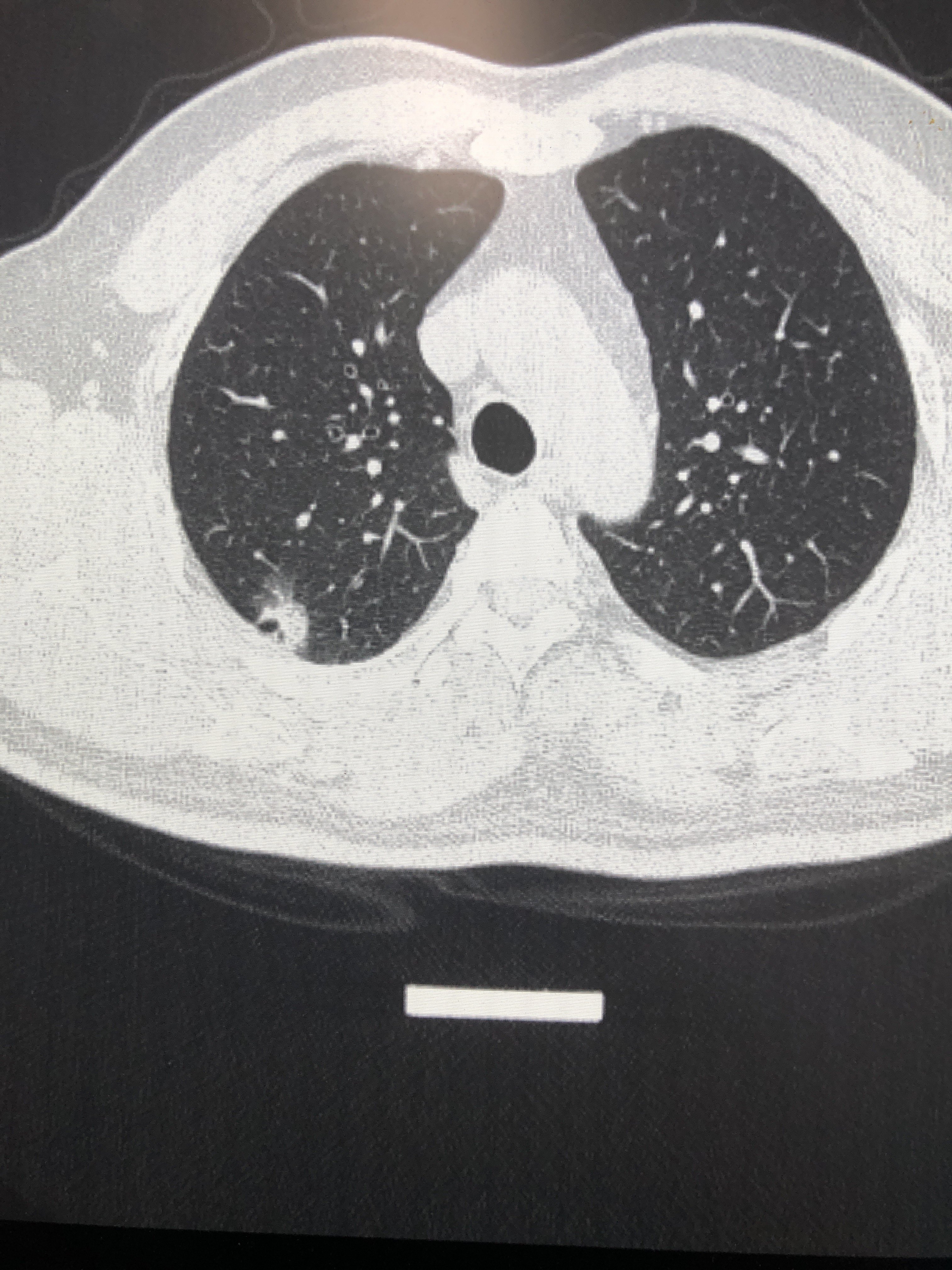 肺结节的真实世界6