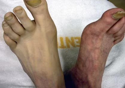 下肢动脉硬化闭塞症不要用热水泡脚 - 好大夫在线