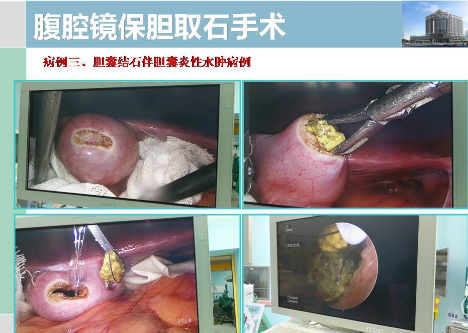 其他保膽病例資料:七,術後腹壁穿刺傷口情況六,膽囊底創口及膽囊周圍