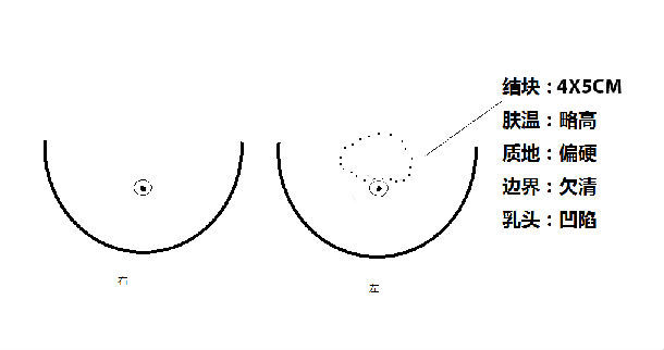 想說愛你不容易——漿細胞性乳腺炎_乳腺導管擴張_乳腺導管擴張疾病