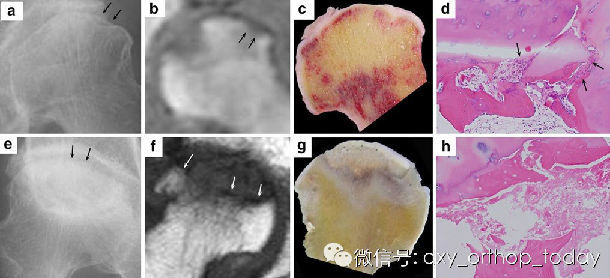 新月征 ≠ 股骨头坏死 - 好大夫在线