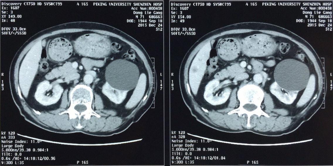 患者,男,72岁,ct显示双肾囊肿,左肾囊肿需要进行外科处理.