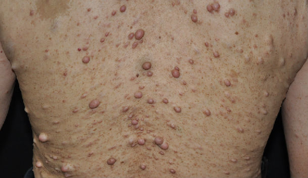 科大夫手把手教您自己确诊宝宝是否为神经纤维瘤