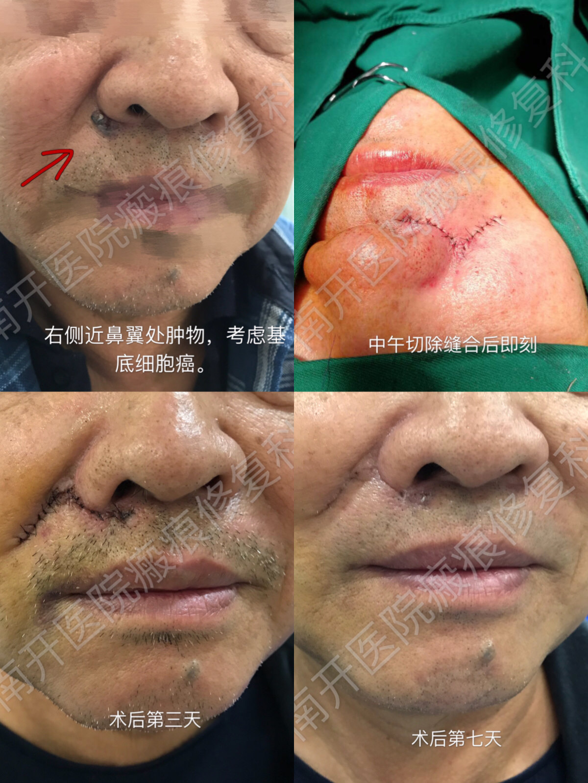 面部基底细胞癌 老年人常见的面部肿物