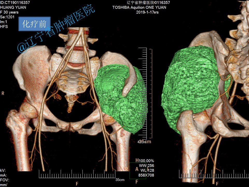 骨盆髂骨肿瘤髂骨次全切除术病例 - 好大夫在线