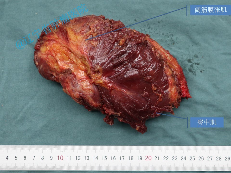 骨盆髂骨肿瘤髂骨次全切除术病例 - 好大夫在线