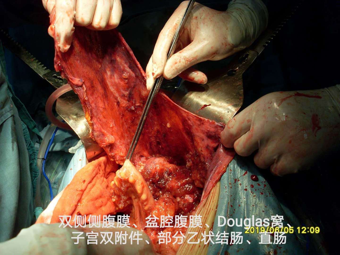 全部大网膜,小网膜,肝圆韧带,部分双膈肌腹膜切除,回结肠吻合 结直肠