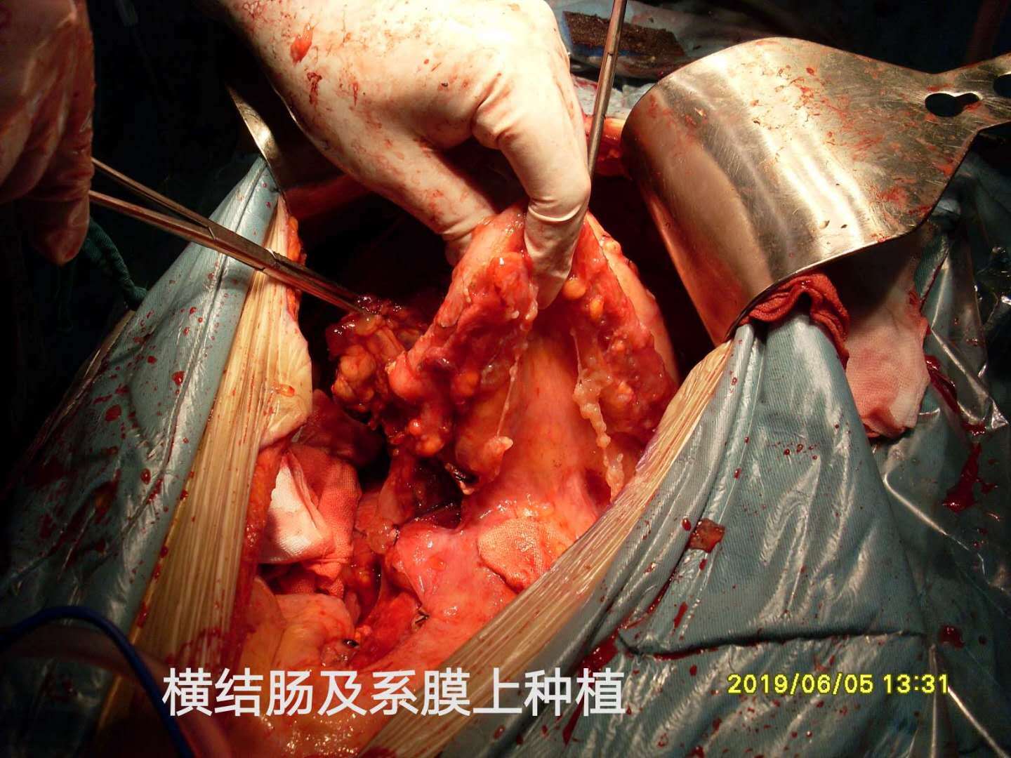 病例72--ct诊断出pmp,证实pmp晚期